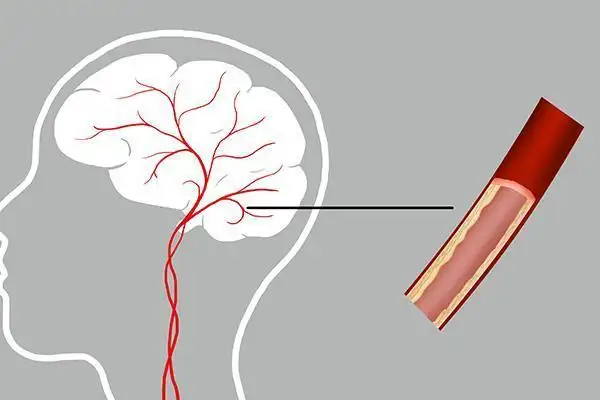 提醒中老年人：腦供血不足時(shí)，身體會(huì)發(fā)出4個(gè)信號(hào)！該如何治療？