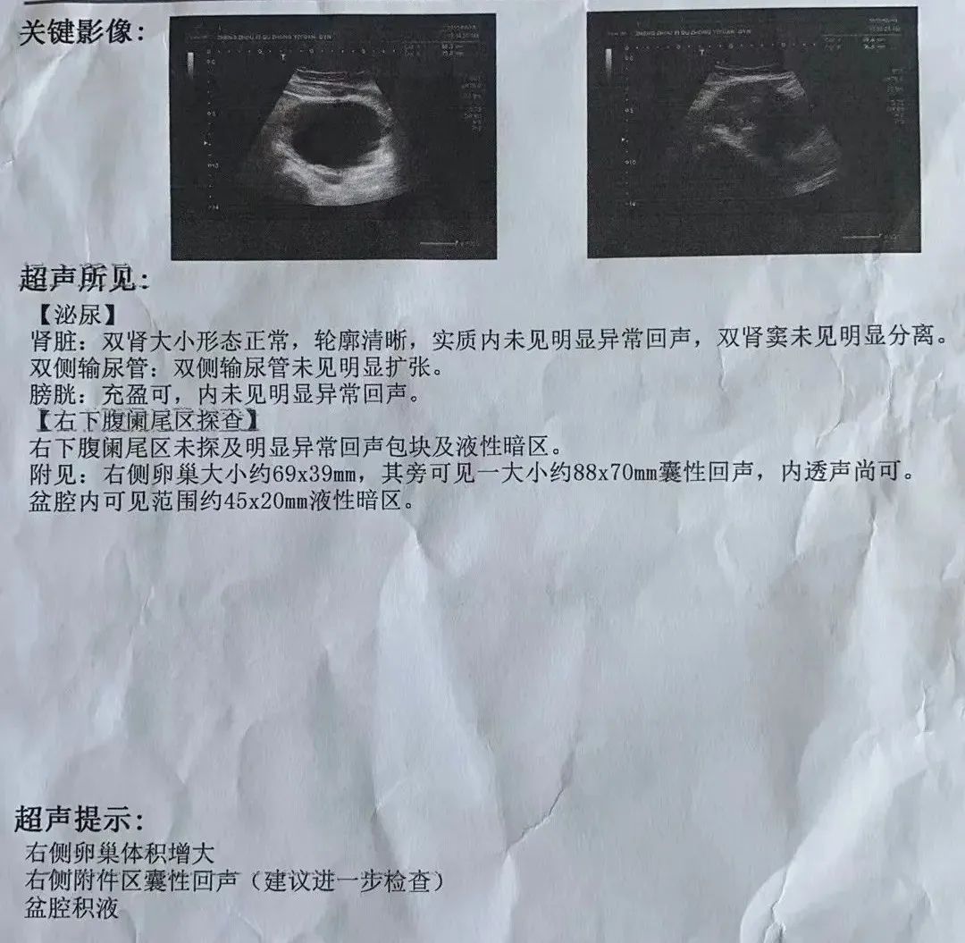 11歲女孩急性腹痛！竟然是卵巢囊腫蒂扭轉(zhuǎn)了