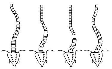 脊柱側(cè)彎如何康復(fù)？河南省中醫(yī)院西區(qū)醫(yī)院專家這樣說